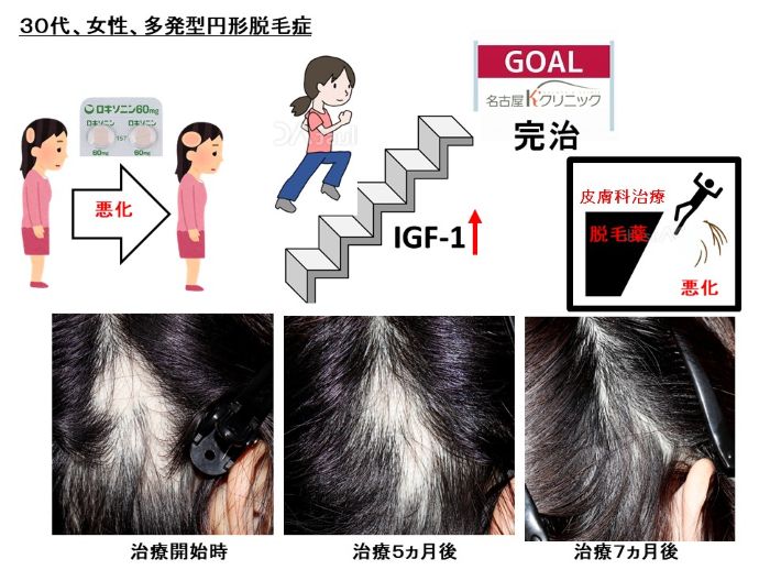 円形脱毛症　病院